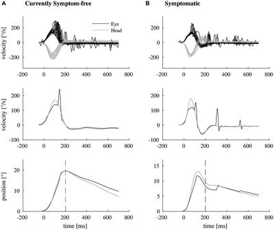 Symptoms in unilateral vestibular hypofunction are associated with number of catch-up saccades and retinal error: results from the population-based KORA FF4 study